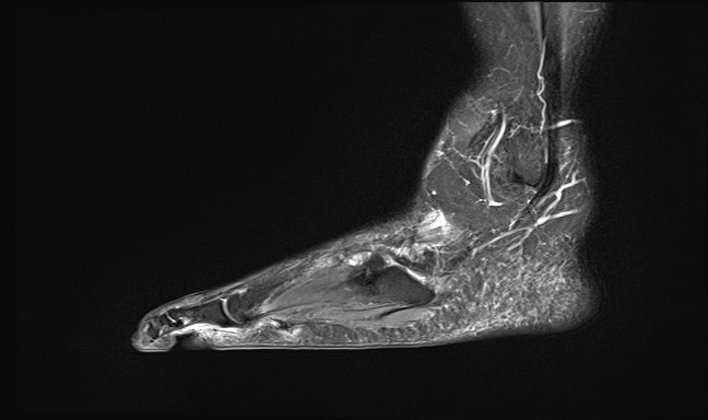 File:Anterior tibial artery false aneurysm (Radiopaedia 88984-105808 Sagittal STIR 6).jpg