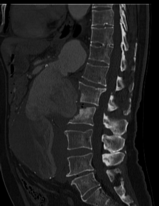 File:Anterior vertebral scalloping (abdominal aortic aneurysm) (Radiopaedia 66744-76067 Sagittal bone window 39).jpg
