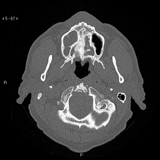 Antrochoanal Polyp (Radiopaedia 70510-80631 Axial bone window 15).jpg