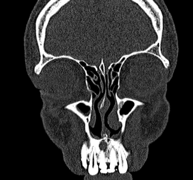 Antrochoanal polyp (Radiopaedia 30002-30554 Coronal bone window 23).jpg