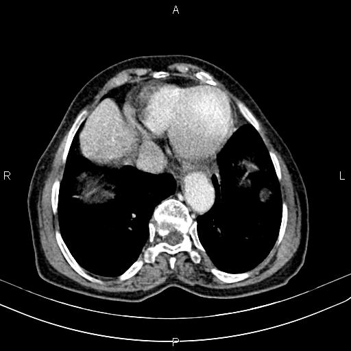 File:Aortic aneurysm and Lemmel syndrome (Radiopaedia 86499-102554 A 9).jpg