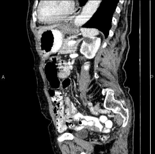 Aortic aneurysm and Lemmel syndrome (Radiopaedia 86499-102554 D 58).jpg