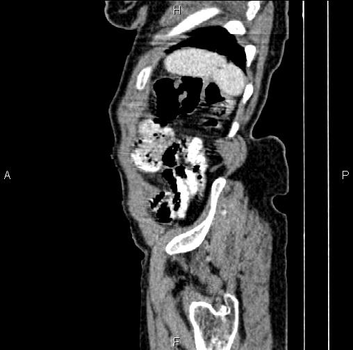 Aortic aneurysm and Lemmel syndrome (Radiopaedia 86499-102554 D 82).jpg