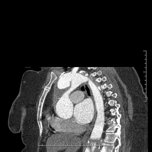 File:Aortic dissection- Stanford A (Radiopaedia 35729-37268 D 23).jpg