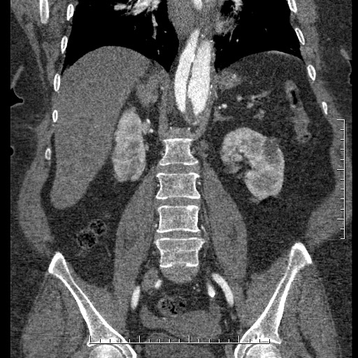 Aortic dissection- Stanford A (Radiopaedia 35729-37268 F 20).jpg