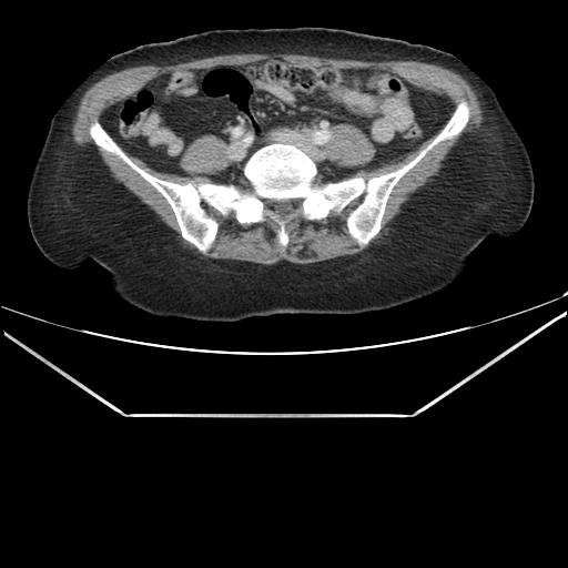 File:Aortic dissection (Radiopaedia 25350-25604 C 78).jpg