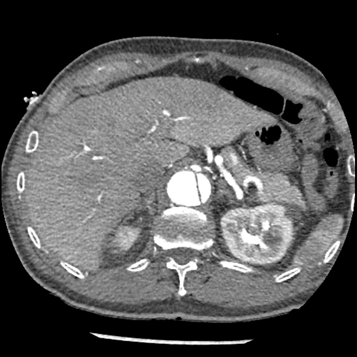 Aortic dissection - DeBakey Type I-Stanford A (Radiopaedia 79863-93115 A 40).jpg