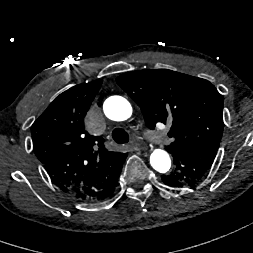 Aortic dissection - DeBakey type II (Radiopaedia 64302-73082 A 30).png