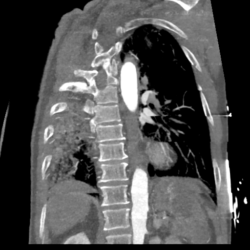 File:Aortic dissection - DeBakey type II (Radiopaedia 64302-73082 D 21).png