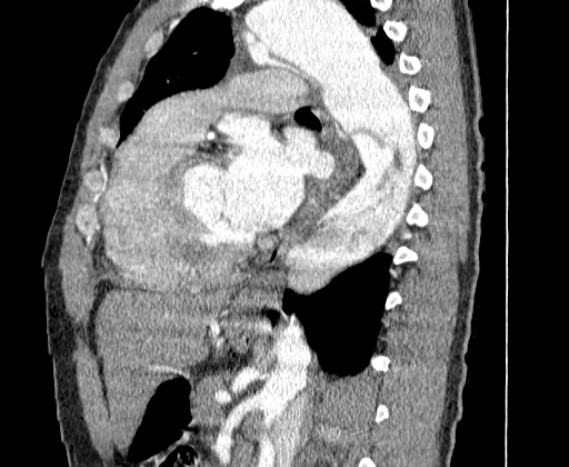 File:Aortic dissection - Stanford A -DeBakey I (Radiopaedia 28339-28587 C 48).jpg