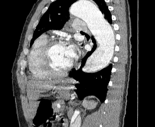 Aortic dissection - Stanford A -DeBakey I (Radiopaedia 28339-28587 C 56).jpg
