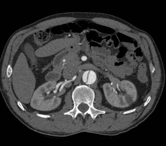 Aortic dissection - Stanford type B (Radiopaedia 73648-84437 A 141).jpg