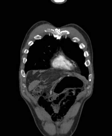 Aortic dissection - Stanford type B (Radiopaedia 73648-84437 B 18).jpg