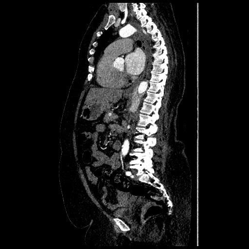 File:Aortic dissection - Stanford type B (Radiopaedia 88281-104910 C 44).jpg