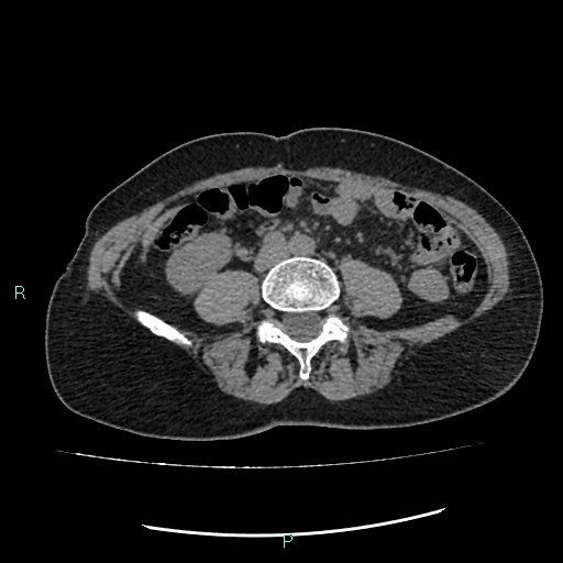 File:Aortic dissection extended to lusory artery (Radiopaedia 43686-47136 Axial non-contrast 41).jpg