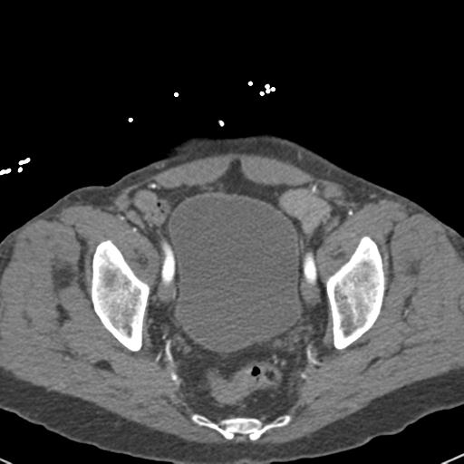 Aortic intramural hematoma (Radiopaedia 31139-31838 B 154).jpg