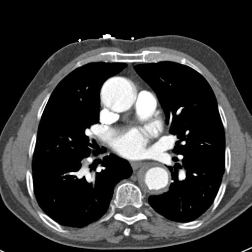 Aortic intramural hematoma (Radiopaedia 31139-31838 B 48).jpg