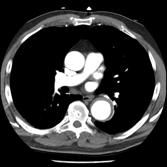 Aortic intramural hematoma (type B) (Radiopaedia 79323-92387 B 26).jpg