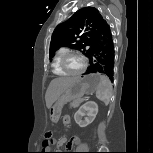 File:Aortic intramural hematoma from penetrating atherosclerotic ulcer (Radiopaedia 31137-31836 B 5).jpg