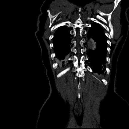 File:Aortic intramural hematoma from penetrating atherosclerotic ulcer (Radiopaedia 31137-31836 C 60).jpg
