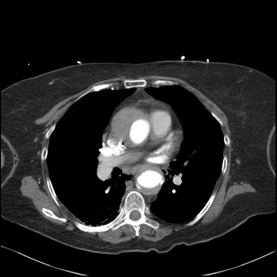 Aortic intramural hematoma with dissection and intramural blood pool (Radiopaedia 77373-89491 B 61).jpg