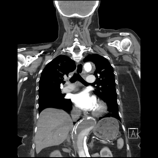 Aortic intramural hematoma with dissection and intramural blood pool (Radiopaedia 77373-89491 C 35).jpg