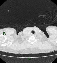 File:Aortic valve endocarditis (Radiopaedia 87209-103485 Axial lung window 4).jpg