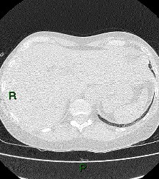 File:Aortic valve endocarditis (Radiopaedia 87209-103485 Axial lung window 90).jpg