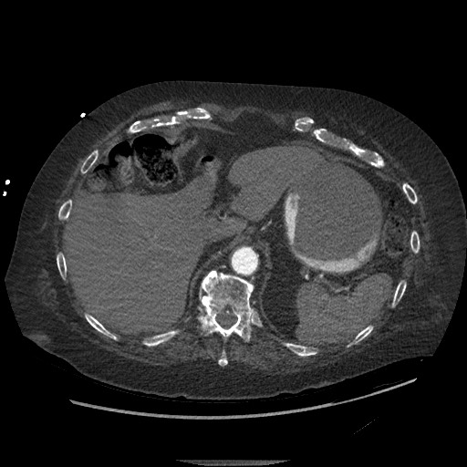 File:Aortoesophageal fistula with endovascular repair (Radiopaedia 73781-84592 Axial C+ CTPA 164).jpg