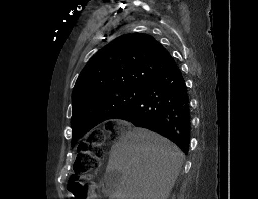 Aortoesophageal fistula with endovascular repair (Radiopaedia 73781-84592 Sagittal C+ CTPA 46).jpg