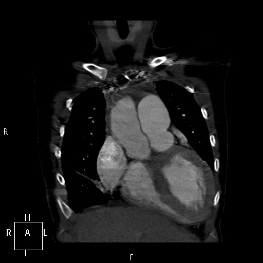 File:Aortopulmonary septal defect (Radiopaedia 41990-45013 Coronal C+ CTPA 11).jpg