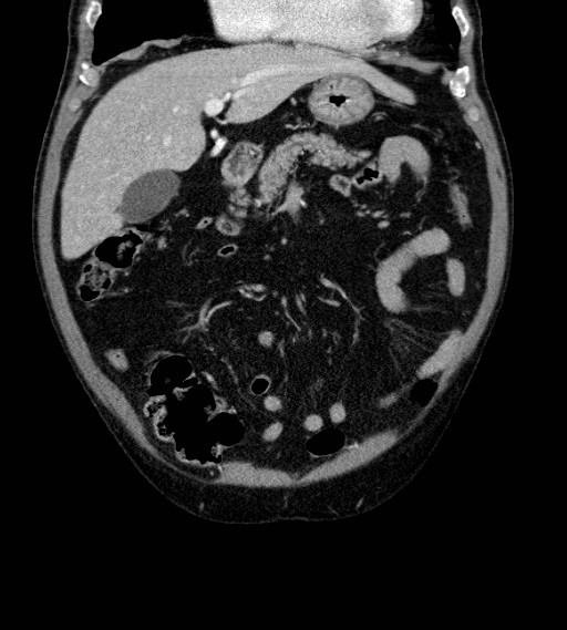 Appendiceal adenocarcinoma complicated by retroperitoneal abscess (Radiopaedia 58007-65039 A 27).jpg