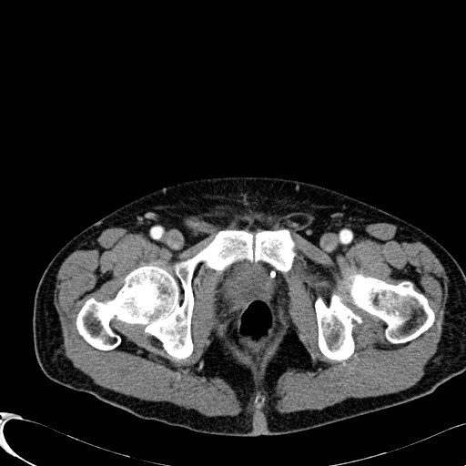 Appendiceal adenocarcinoma complicated by retroperitoneal abscess (Radiopaedia 58007-65039 B 141).jpg