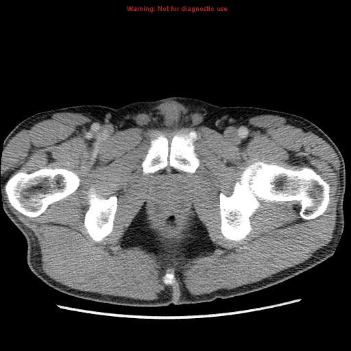 File:Appendicitis and renal cell carcinoma (Radiopaedia 17063-16760 A 58).jpg