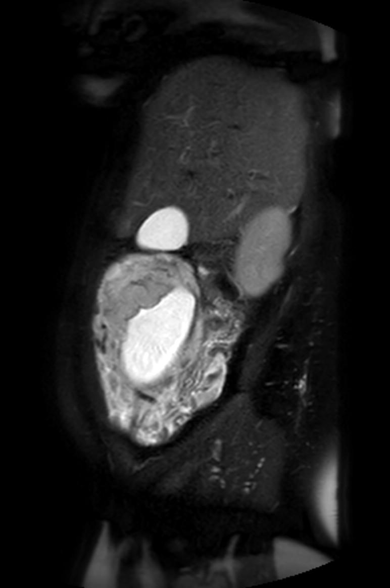 Appendicitis in gravida (MRI) (Radiopaedia 89433-106395 Sagittal T2 SPAIR 49).jpg