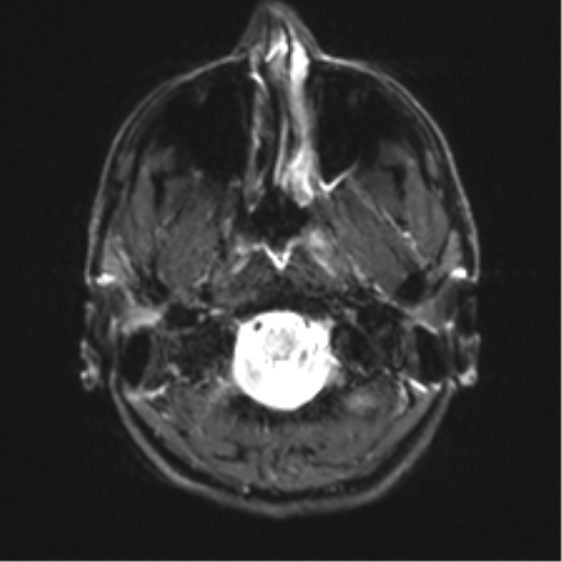 File:Arachnoid cyst - cerebellopontine angle (Radiopaedia 59689-67083 Axial DWI 3).png