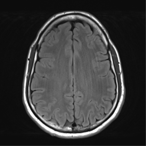 File:Arachnoid cyst - cerebellopontine angle (Radiopaedia 59689-67083 Axial FLAIR 26).png