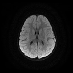 File:Arachnoid cyst - middle cranial fossa (Radiopaedia 86780-102938 Axial DWI 12).jpg