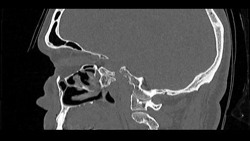 Arcuate foramen (Radiopaedia 89833-106944 Sagittal bone window 85).jpg