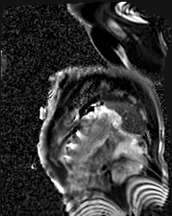 File:Arrhythmogenic right ventricular cardiomyopathy (Radiopaedia 57972-64966 D 13).jpg