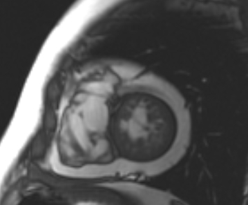 Arrhythmogenic right ventricular cardiomyopathy (Radiopaedia 69431-79307 Short axis cine 70).jpg