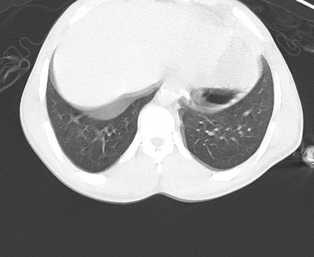 Arrow injury to the chest (Radiopaedia 75223-86321 Axial lung window 81).jpg