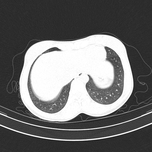 Arteria lusoria (Radiopaedia 88528-105192 Axial lung window 50).jpg