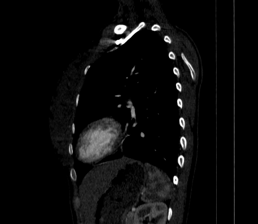 Arteria lusoria (Radiopaedia 88528-105192 C 67).jpg