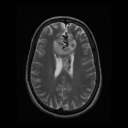 File:Arteriovenous malformation (cerebral) (Radiopaedia 40070-42580 Axial T2 16).png