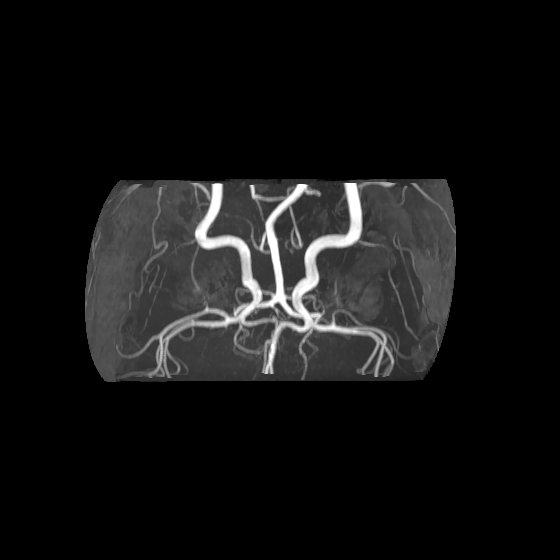 Artery of Percheron infarct (Radiopaedia 40966-43676 F 60).jpg