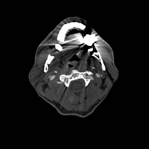 Artery of Percheron infarct (Radiopaedia 48088-52894 A 89).jpg