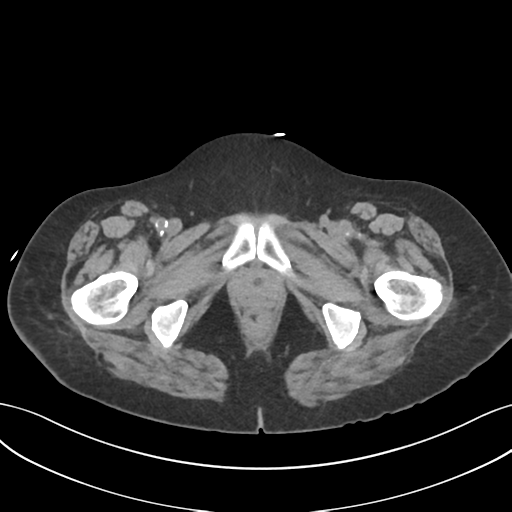 File:Ascending cholangitis (Radiopaedia 39068-41253 Axial non-contrast 71).png