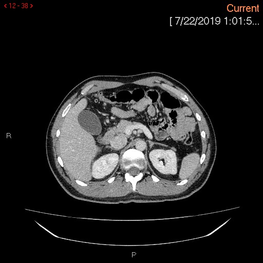 File:Ascending colonic diverticulum mimicking acute appendicitis (Radiopaedia 69943-80198 A 38).jpg