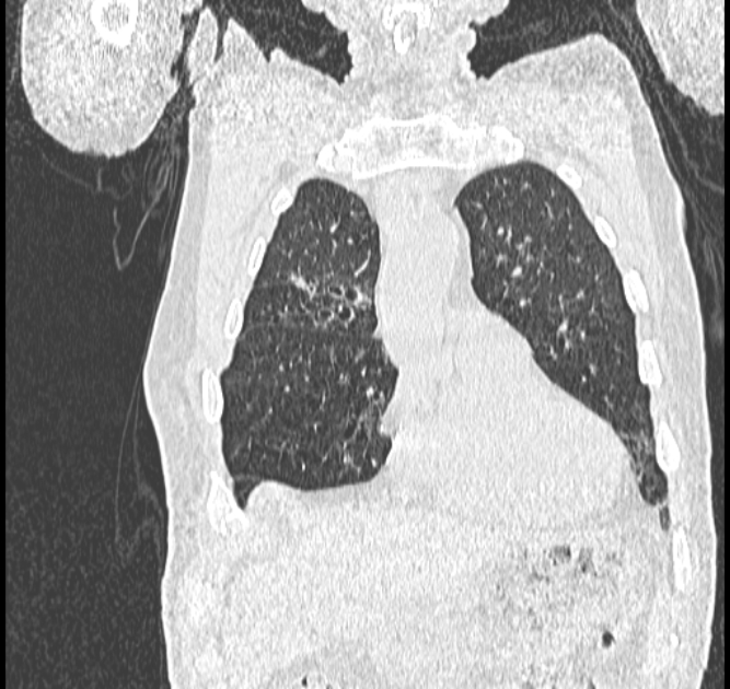 Aspergilloma (Radiopaedia 44592-48327 Coronal lung window 23).jpg